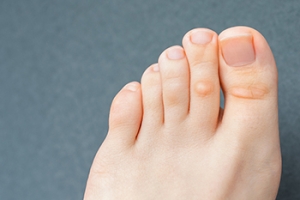 Causes and Relief for Foot Corns