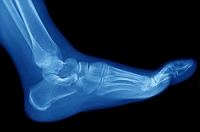 What Causes Metatarsal Fractures?