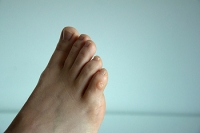 Unraveling the Causes of Bunions
