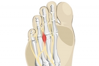 Painful Symptoms Are Often Associated With Morton’s Neuroma