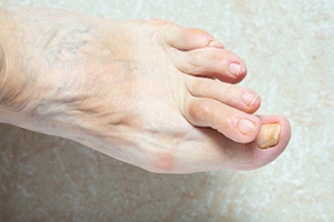 Diagnosis and Causes of Hammertoe