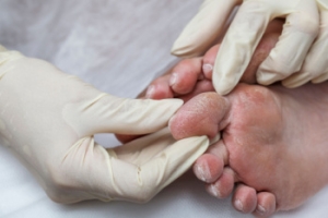 The Importance of Diabetic Foot Care