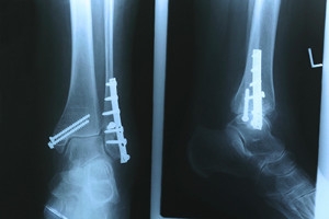 Ankle Fracture Surgery Facts
